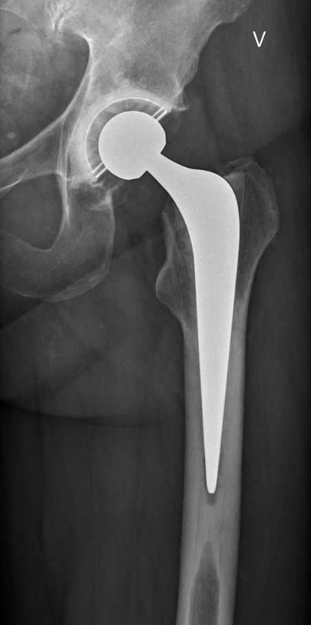 Røntgenbilde av hofteprotese