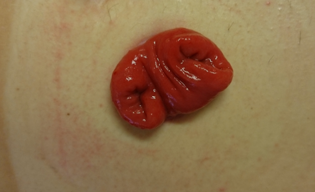 To løpet transversostomi